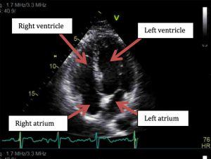 Still frame echocardiography