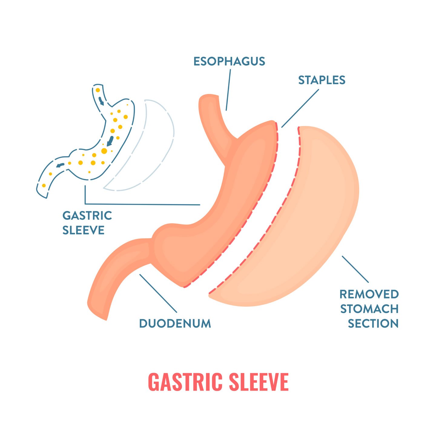 Gastric sleeve
